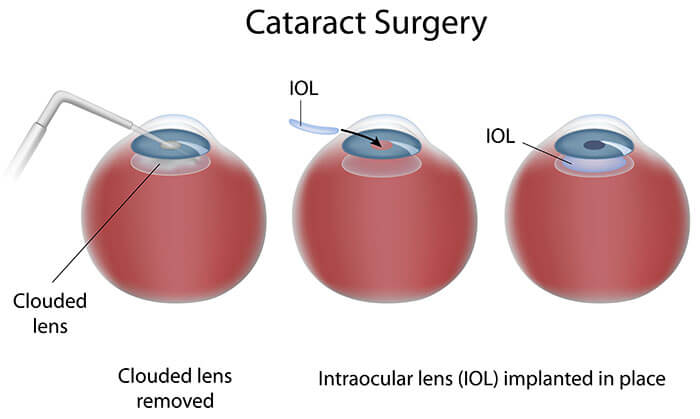 Chart Illustrating the Cataract Surgery Process