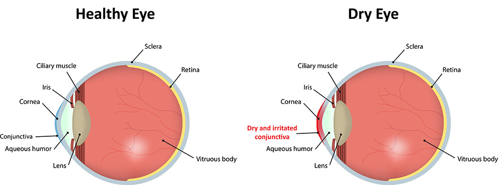 Chart Illustrating a Healthy Eye Compared to One With Dry Eye