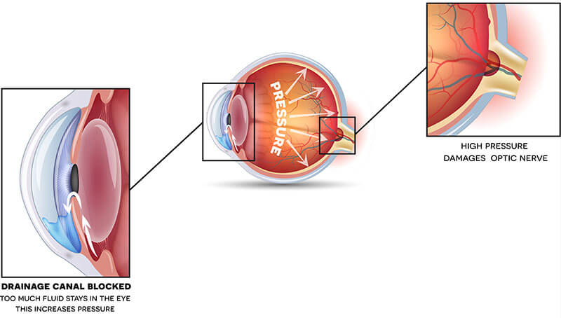 Chart Illustrating How Glaucoma Affects an Eye